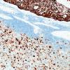 51B2 Metastasis, giant cell lung CA (Case 51) CAM5.2 1
