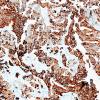 51C Metastasis, giant cell lung CA (Case 51) CK7 4