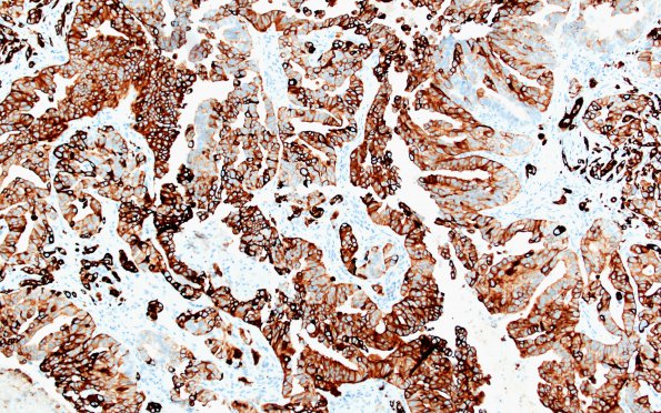 51C Metastasis, giant cell lung CA (Case 51) CK7 4