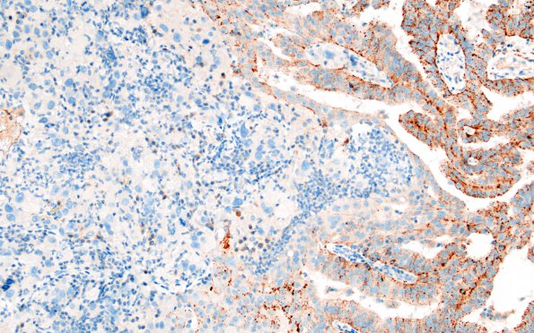 51D Metastasis, giant cell lung CA (Case 51) NapsinA 1