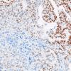 51E Metastasis, giant cell lung CA (Case 51) TTF1 1