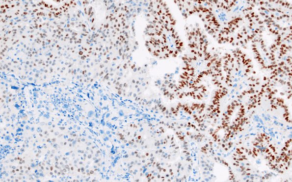 51E Metastasis, giant cell lung CA (Case 51) TTF1 1