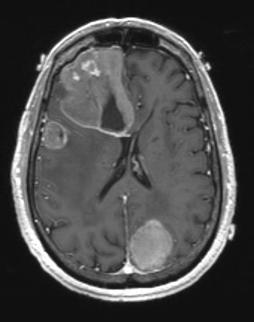 52A Metastasis, large cell neuroendocrine CA (Case 52) T1 W 1