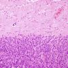 52B1 Metastasis, large cell neuroendocrine CA (Case 52) H&E 11.jpg