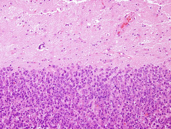 52B1 Metastasis, large cell neuroendocrine CA (Case 52) H&E 11.jpg