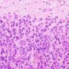 52B2 Metastasis, large cell neuroendocrine CA (Case 52) H&E 12.jpg