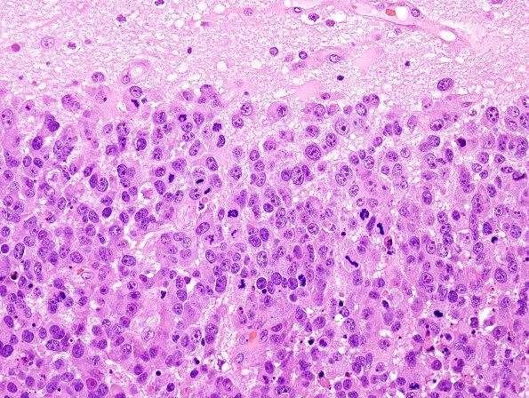 52B2 Metastasis, large cell neuroendocrine CA (Case 52) H&E 12.jpg