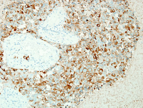 52C1 Metastasis, large cell neuroendocrine CA (Case 52) SYN 2.jpg