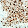 52C2 Metastasis, large cell neuroendocrine CA (Case 52) Chromogranin 1.jpg