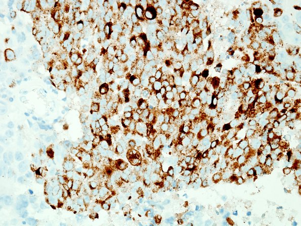 52C2 Metastasis, large cell neuroendocrine CA (Case 52) Chromogranin 1.jpg