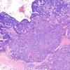 53A1 Metastasis, large cell neuroendocrine CA (Case 53) H&E 10