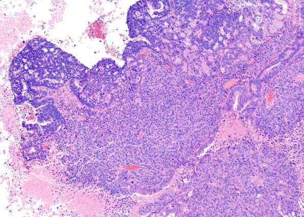 53A1 Metastasis, large cell neuroendocrine CA (Case 53) H&E 10