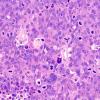 53A2 Metastasis, large cell neuroendocrine type (Case 53) H&E 1