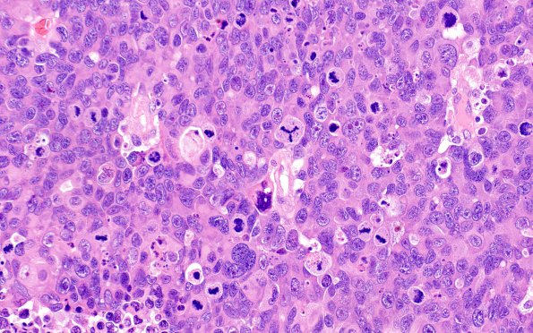 53A2 Metastasis, large cell neuroendocrine type (Case 53) H&E 1