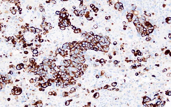53B Metastasis, large cell neuroendocrine type (Case 53) CK7