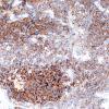 53C1 large cell neuroendocrine (Case 53) SYN 5