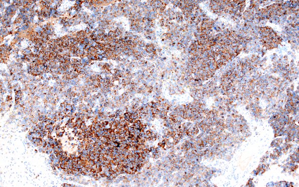 53C1 large cell neuroendocrine (Case 53) SYN 5