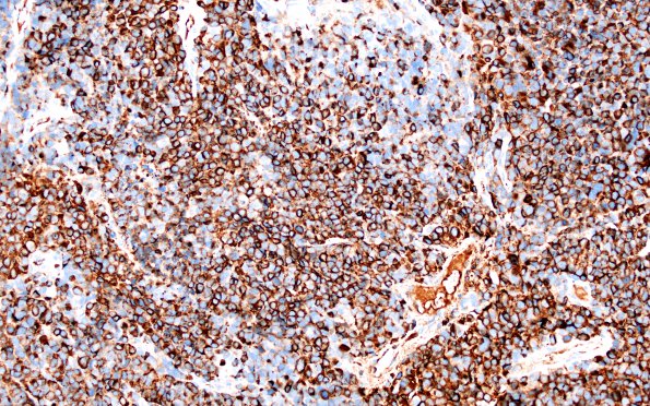 53C2 large cell neuroendocrine type (Case 53) CHR 1