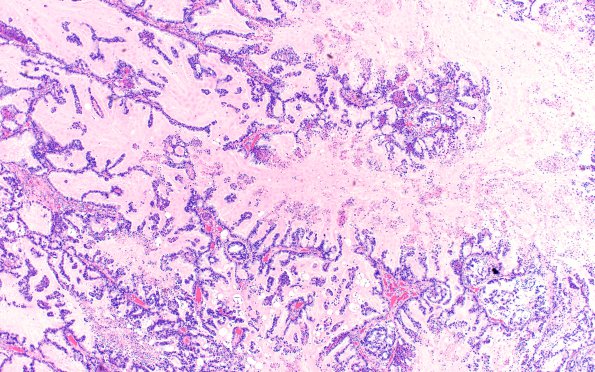 54A1 Metastasis, mucinous lung CA (Case 54) H&E 4X