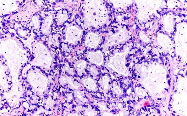 54A2 Metastasis, mucinous lung CA (Case 54) H&E 10X