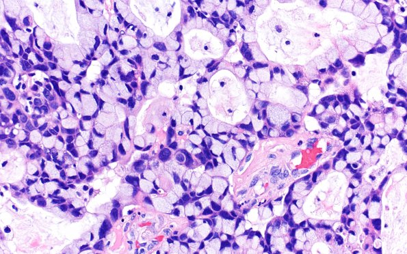 54A3 Metastasis, mucinous lung CA (Case 54) H&E 40X