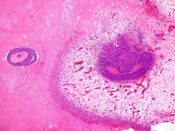 55A Metastasis, lung (Case 55) H&E 3.jpg