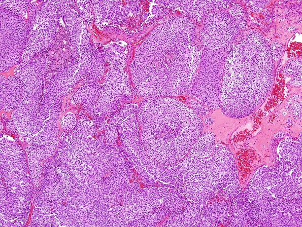 56B1 Metastasis, lung, neuroendocrine carcinoma (Case 56) H&E 1.jpg