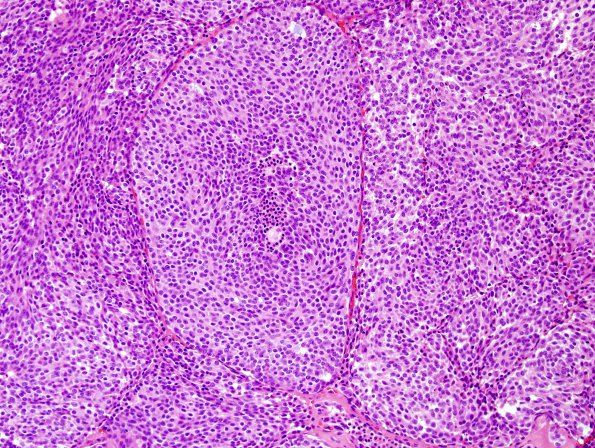 56B2 Metastasis, lung, neuroendocrine carcinoma (Case 56) H&E 3.jpg