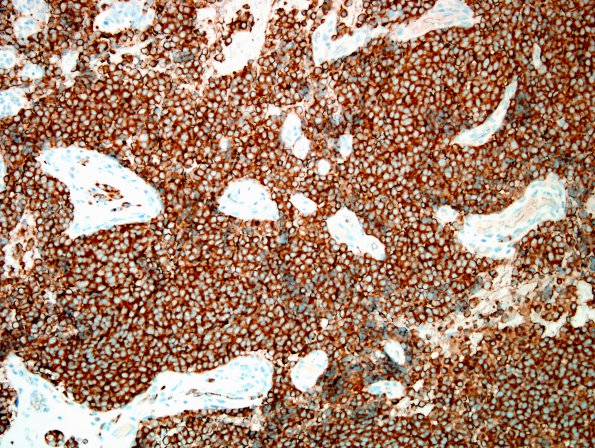 56C Metastasis, lung, neuroendocrine carcinoma (Case 56) SYN 2.jp