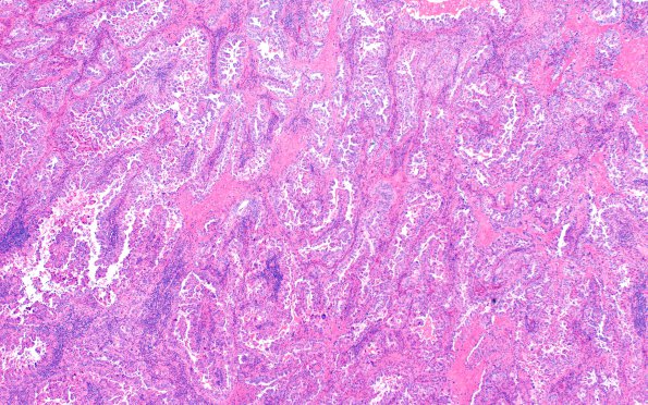 57A1 Metastasis, lung (Case 57) H&E 5