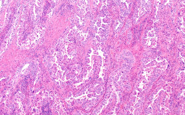 57A2 Metastasis, lung (Case 57) H&E 4