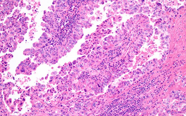 57A3 Metastasis, lung (Case 57) H&E 3