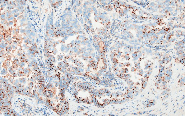 57B Metastasis, lung (Case 57) NapsinA 1