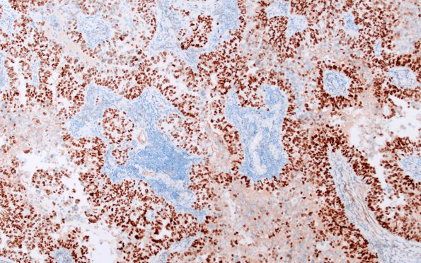 57C Metastasis, lung (Case 57) TTF1 1