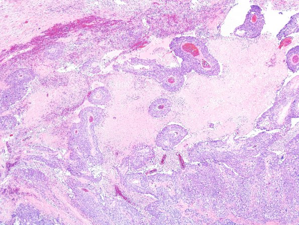 58A Metastasis, lung (Case 58) H&E 2