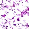 59A1 Metastasis, lung (Case 59) H&E smear 1