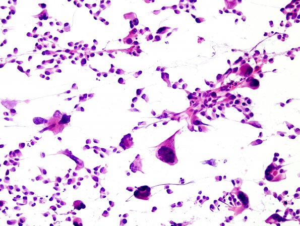 59A1 Metastasis, lung (Case 59) H&E smear 1