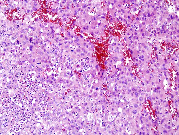 59A2 Metastasis, lung (Case 59) H&E