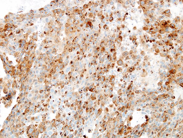 59B Metastasis, lung (Case 59) Napsin