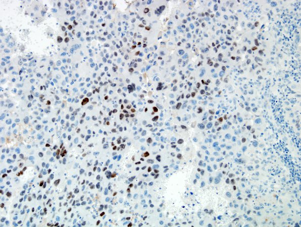 59C Metastasis, lung (Case 59) TTF 1