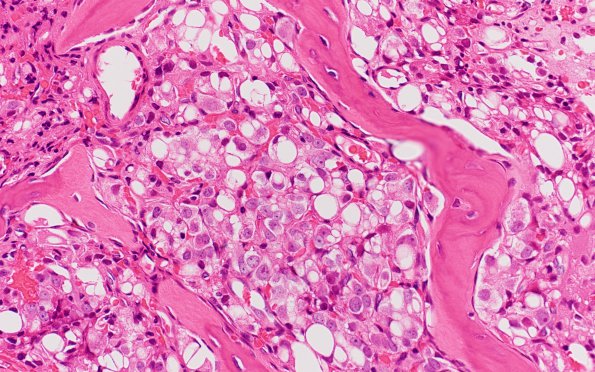 5A1 Metastasis, prostate (Case 5)  H&E 5