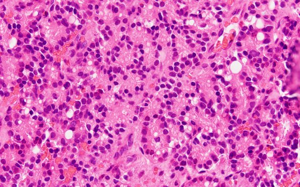 5A2 Metastasis, prostate (Case 5)  H&E 3
