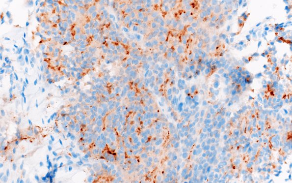 5B1 Metastasis, prostate (Case 5)  PSA 3