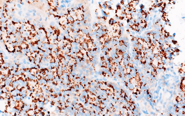 5B2 Metastasis, prostate (Case 5)  Prostein 1