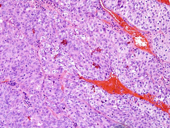 60A Metastasis, lung (Case 60) H&E 1.jpg