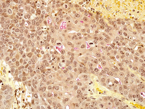 60B Metastasis, lung (Case 60) mucicarmine 2.jpg