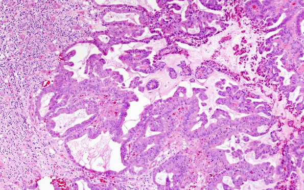 61A Metastasis, lung (Case 61) H&E 2