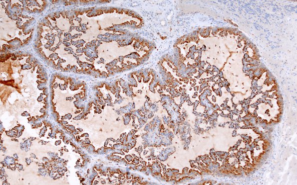 61B Metastasis, lung (Case 61) Napsin A 3