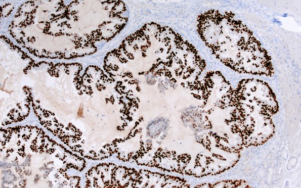 61C Metastasis, lung (Case 61) TTF-1 2