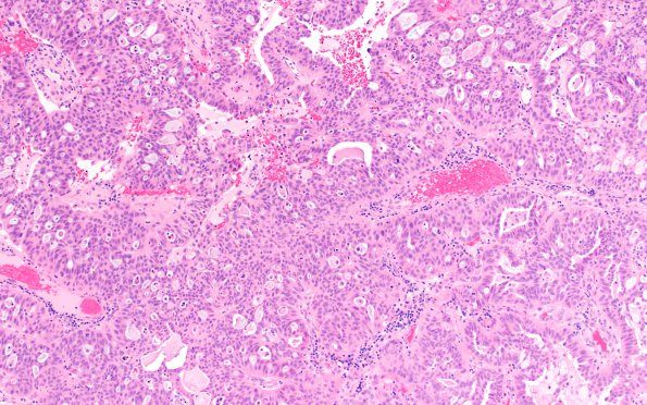 62A Metastasis, Lung adeno (Case 62) H&E 10X